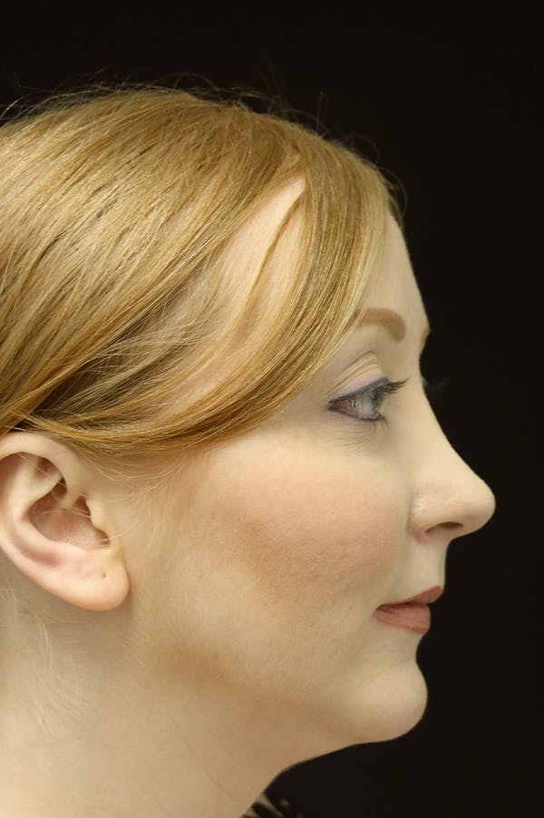 Revision Rhinoplasty Before & After Gallery - Patient 24222651 - Image 2