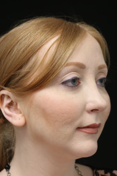 Revision Rhinoplasty Before & After Gallery - Patient 24222651 - Image 4