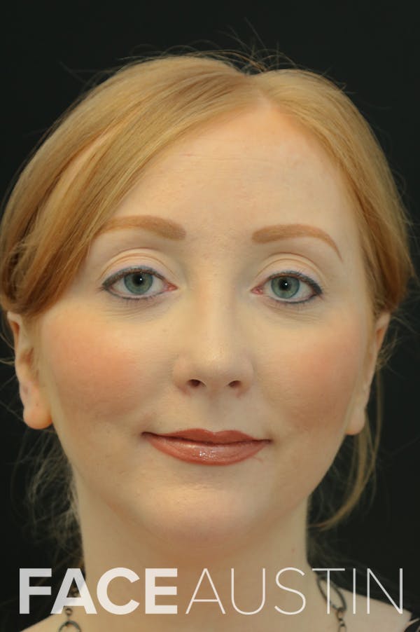 Revision Rhinoplasty Before & After Gallery - Patient 24222651 - Image 6