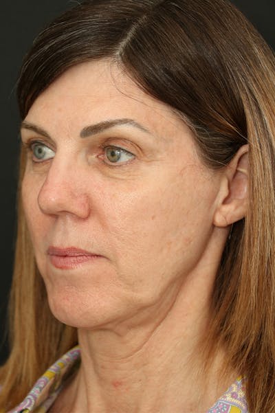 Facelift Before & After Gallery - Patient 24311064 - Image 1
