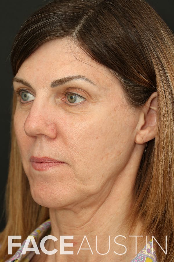 Facelift Before & After Gallery - Patient 24311064 - Image 1