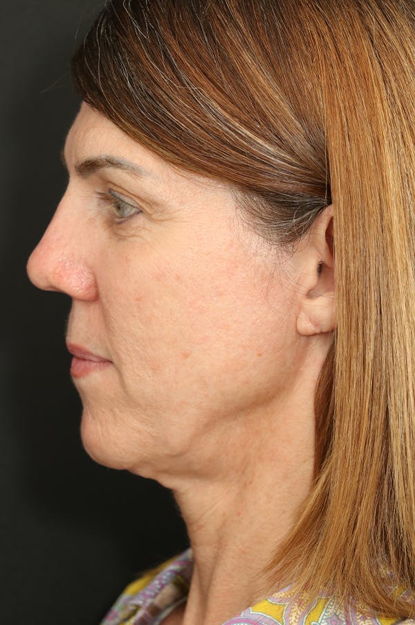 Facelift Before & After Gallery - Patient 24311064 - Image 3