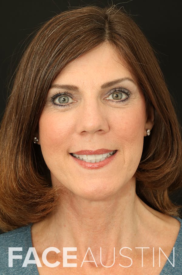 Facelift Before & After Gallery - Patient 24311064 - Image 6