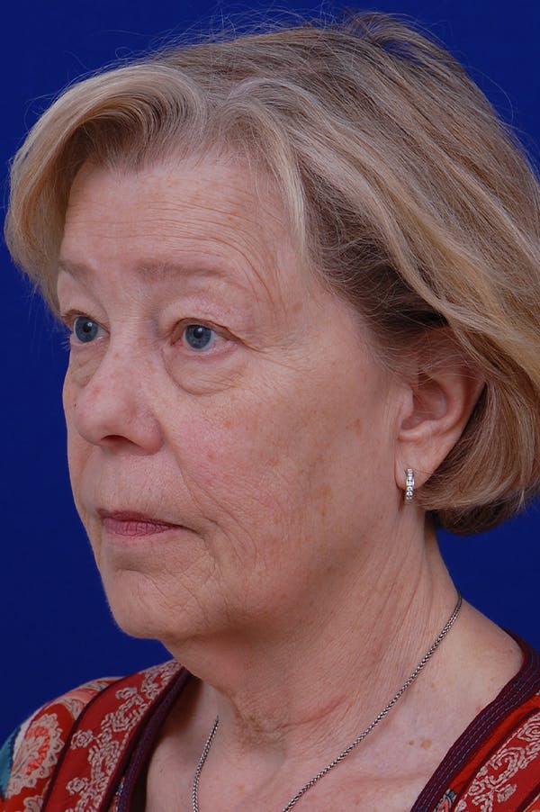 Facelift Before & After Gallery - Patient 24311065 - Image 1
