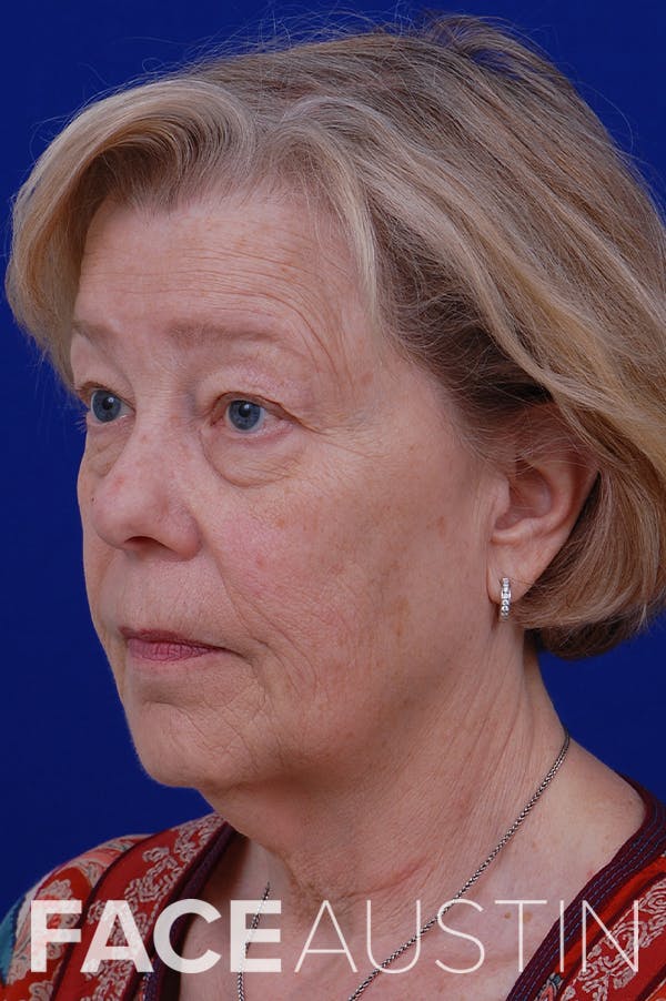 Facelift Before & After Gallery - Patient 24311065 - Image 1