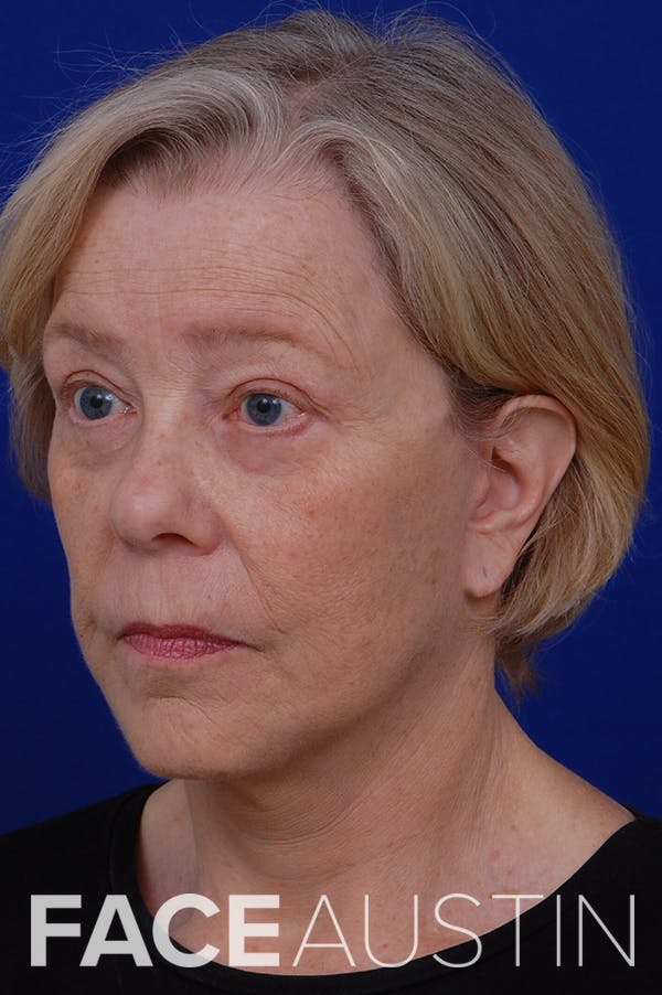 Facelift Before & After Gallery - Patient 24311065 - Image 2