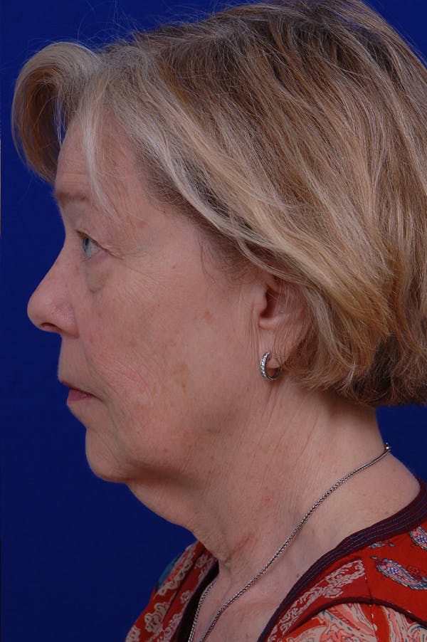 Facelift Before & After Gallery - Patient 24311065 - Image 3
