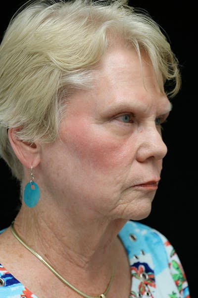 Facelift Before & After Gallery - Patient 24311066 - Image 1