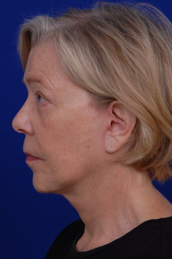Facelift Before & After Gallery - Patient 24311065 - Image 4