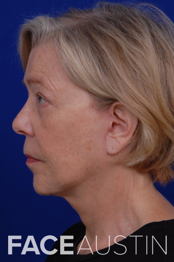 Facelift Before & After Gallery - Patient 24311065 - Image 4