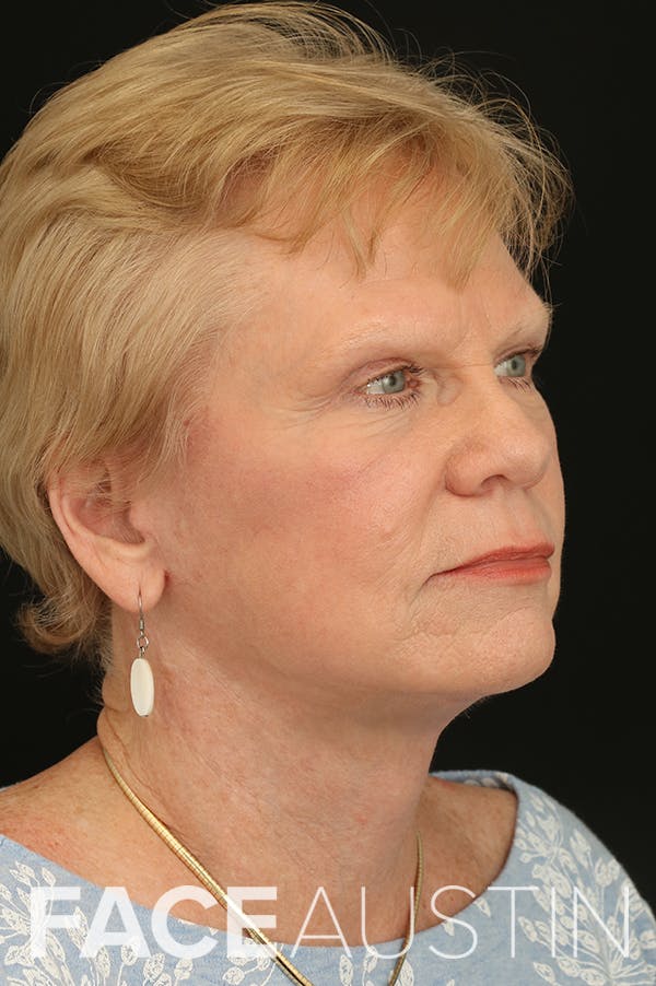 Facelift Before & After Gallery - Patient 24311066 - Image 2