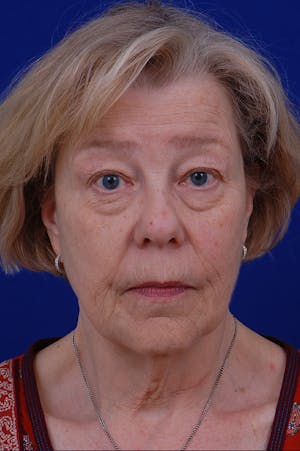 Facelift