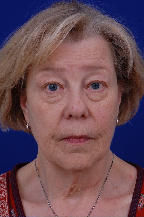 Facelift Before & After Gallery - Patient 24311065 - Image 5