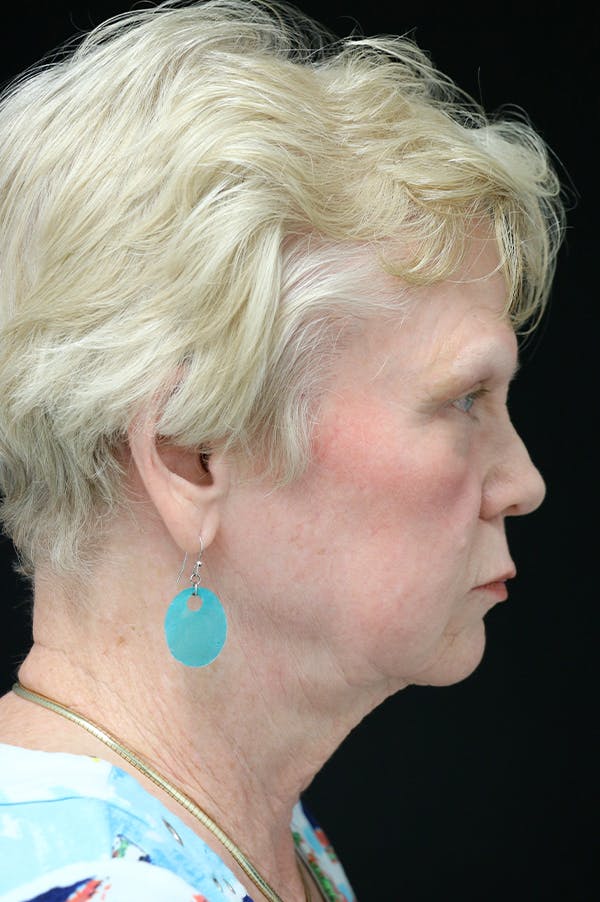 Facelift Before & After Gallery - Patient 24311066 - Image 3