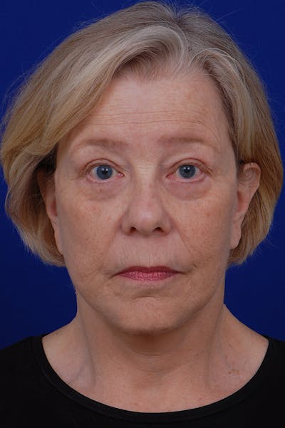 Facelift Before & After Gallery - Patient 24311065 - Image 6