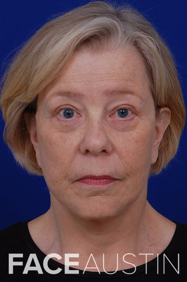 Facelift Before & After Gallery - Patient 24311065 - Image 6