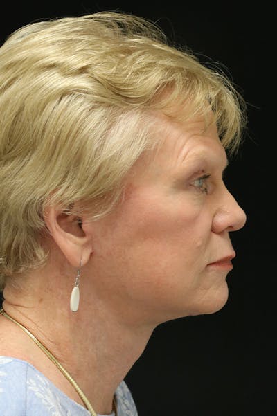 Facelift Before & After Gallery - Patient 24311066 - Image 4