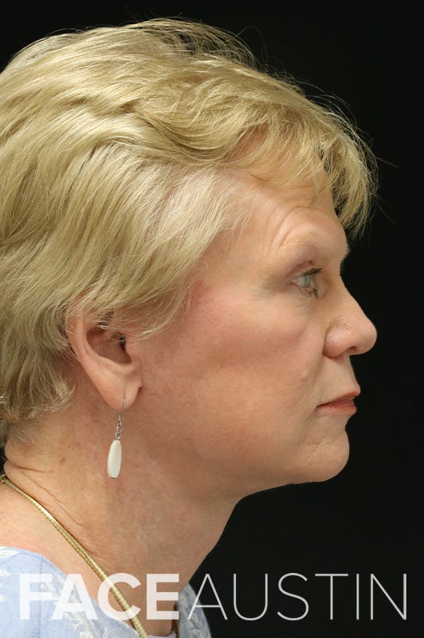 Facelift Before & After Gallery - Patient 24311066 - Image 4