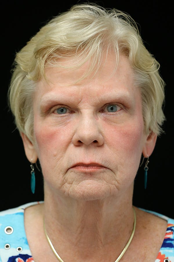 Facelift Before & After Gallery - Patient 24311066 - Image 5