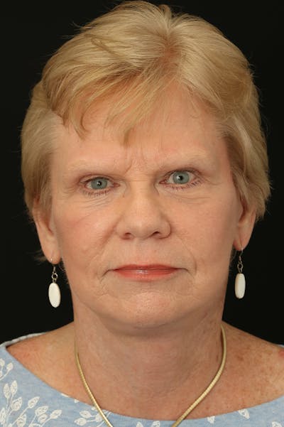 Facelift Before & After Gallery - Patient 24311066 - Image 6