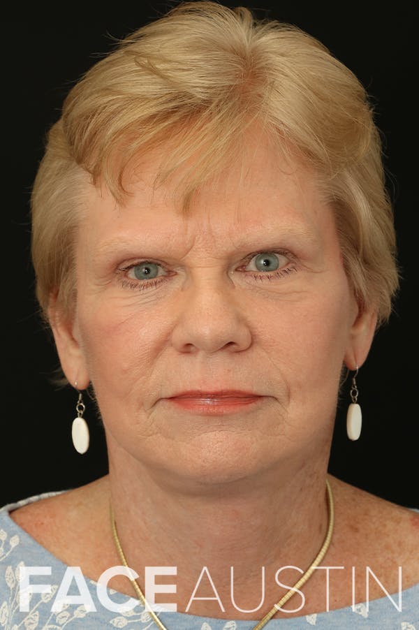 Facelift Before & After Gallery - Patient 24311066 - Image 6