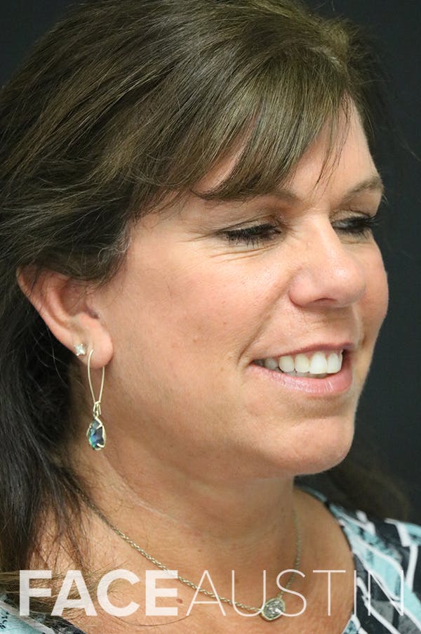 Facelift Before & After Gallery - Patient 24311067 - Image 2