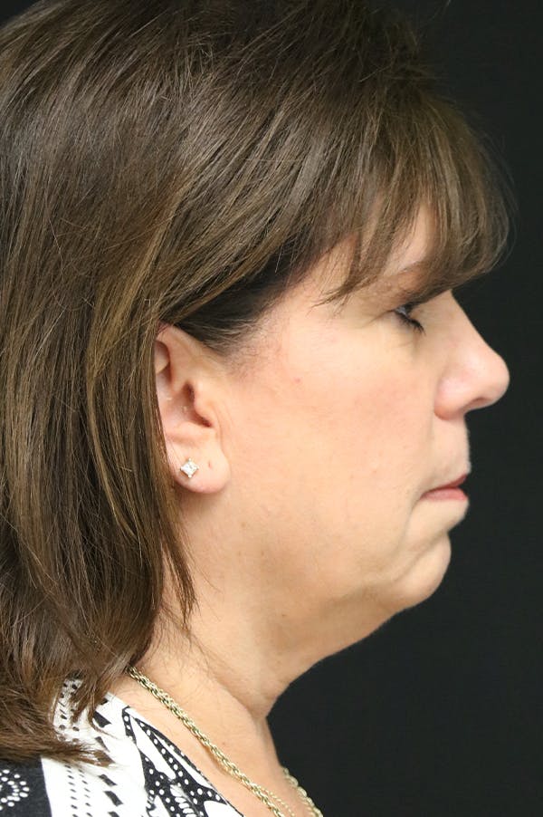 Facelift Before & After Gallery - Patient 24311067 - Image 3