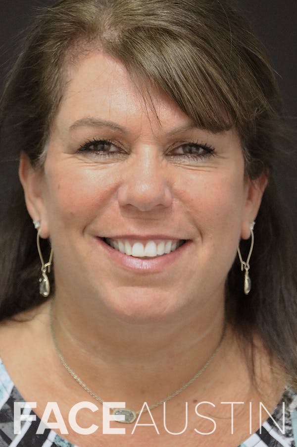 Facelift Before & After Gallery - Patient 24311067 - Image 6