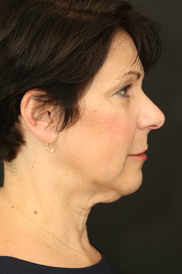 Facelift Before & After Gallery - Patient 24311068 - Image 3