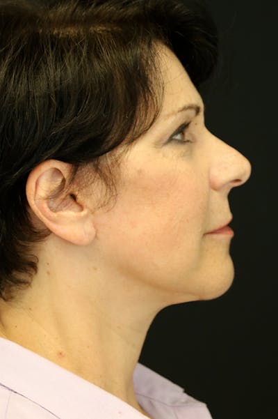 Facelift Before & After Gallery - Patient 24311068 - Image 4