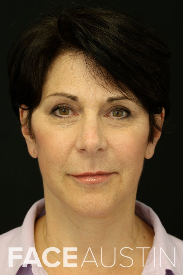 Facelift Before & After Gallery - Patient 24311068 - Image 6