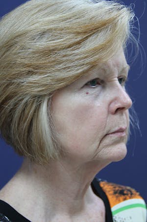 Facelift female patient