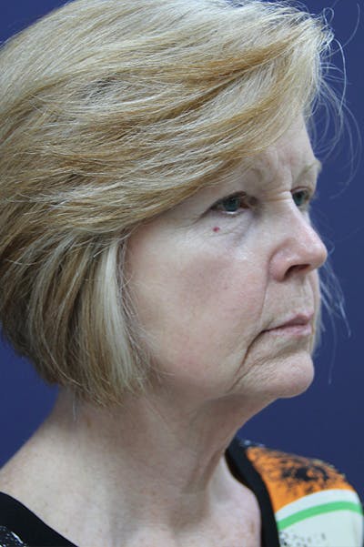 Facelift Before & After Gallery - Patient 24311069 - Image 1