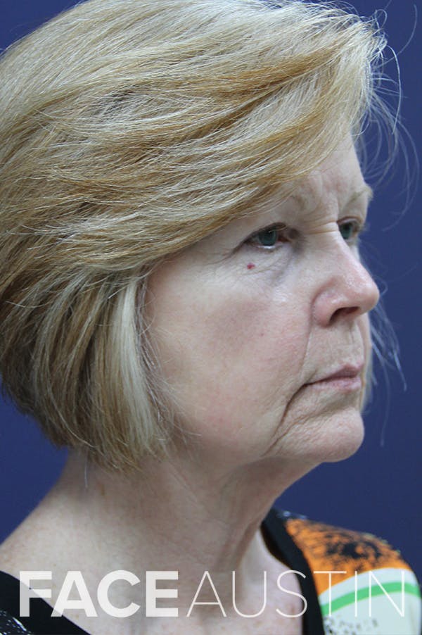Facelift Before & After Gallery - Patient 24311069 - Image 1