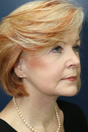 Facelift female patient