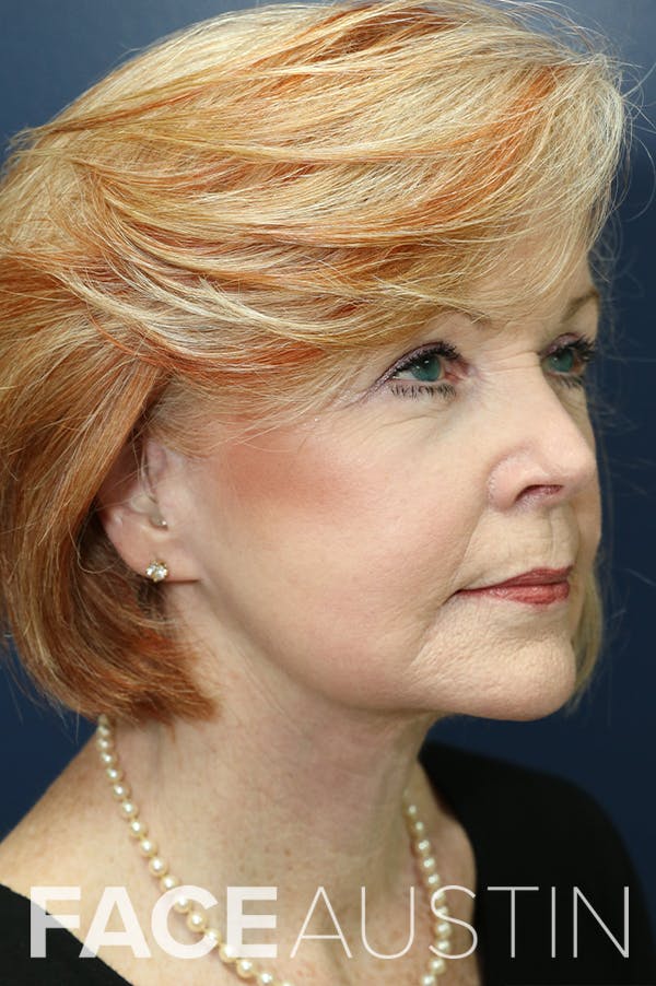 Facelift Before & After Gallery - Patient 24311069 - Image 2