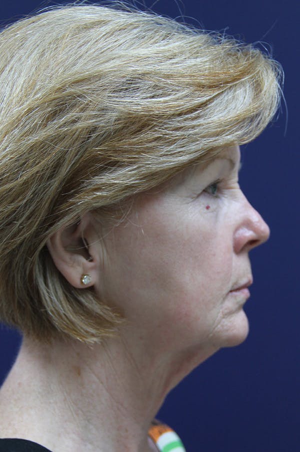 Facelift Before & After Gallery - Patient 24311069 - Image 3