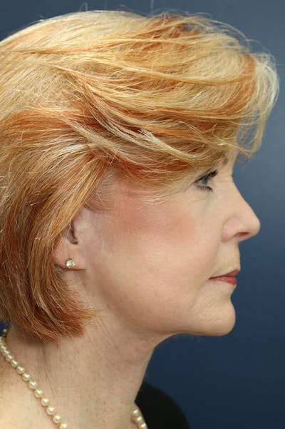 Facelift Before & After Gallery - Patient 24311069 - Image 4