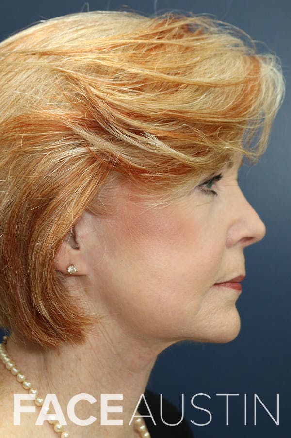 Facelift Before & After Gallery - Patient 24311069 - Image 4