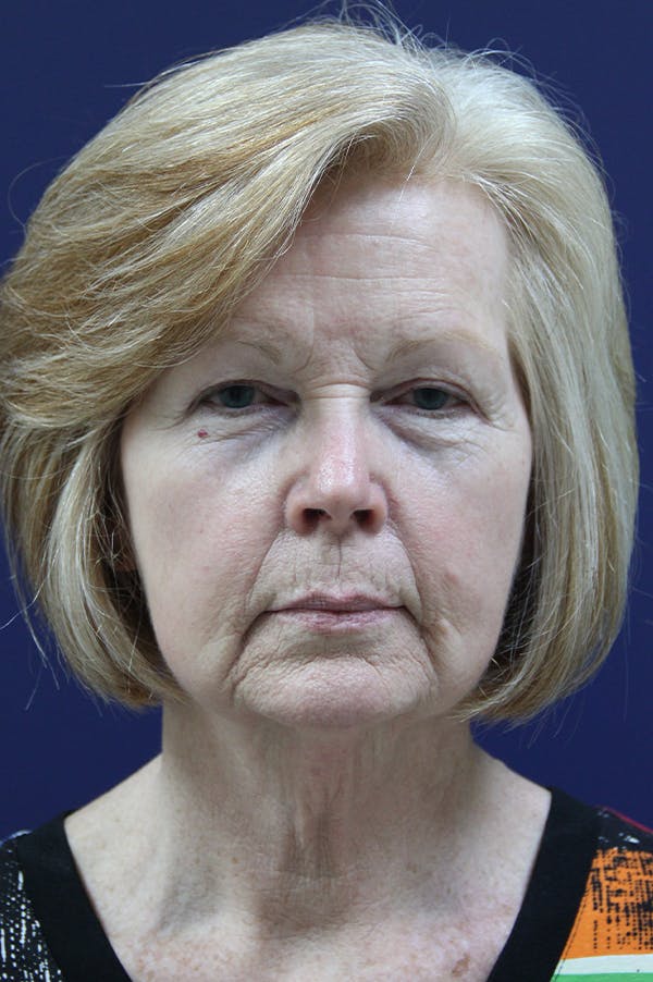Facelift Before & After Gallery - Patient 24311069 - Image 5