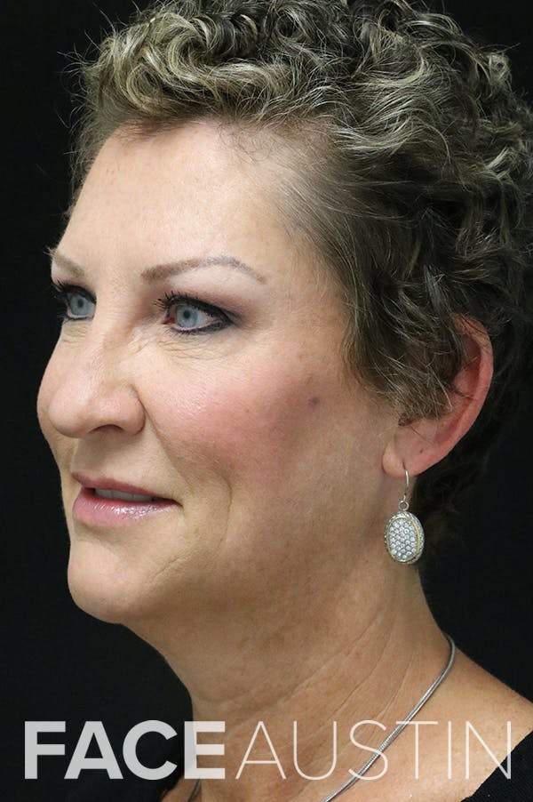 Facelift Before & After Gallery - Patient 24311070 - Image 1