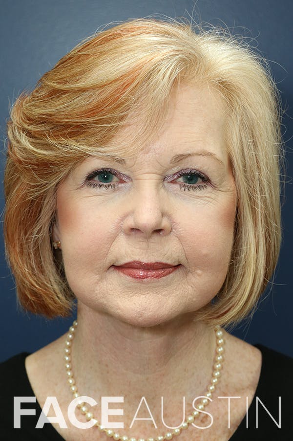 Facelift Before & After Gallery - Patient 24311069 - Image 6