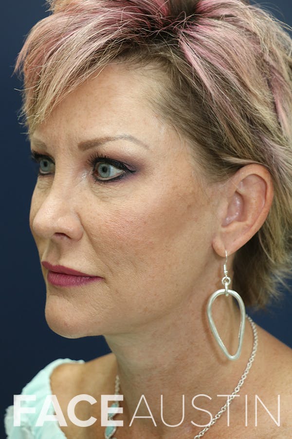 Facelift Before & After Gallery - Patient 24311070 - Image 2
