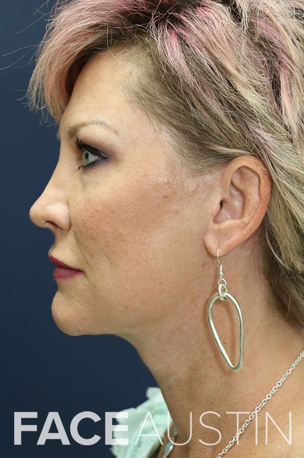 Facelift Before & After Gallery - Patient 24311070 - Image 4