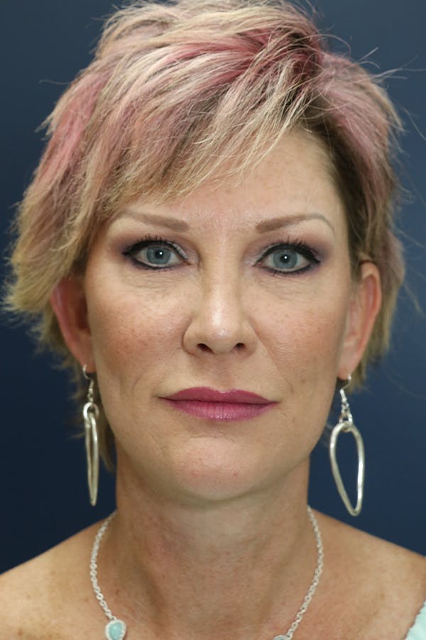Facelift Before & After Gallery - Patient 24311070 - Image 6