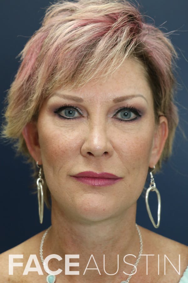 Facelift Before & After Gallery - Patient 24311070 - Image 6