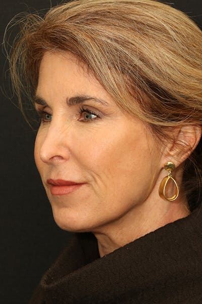 Facelift Before & After Gallery - Patient 24311071 - Image 1