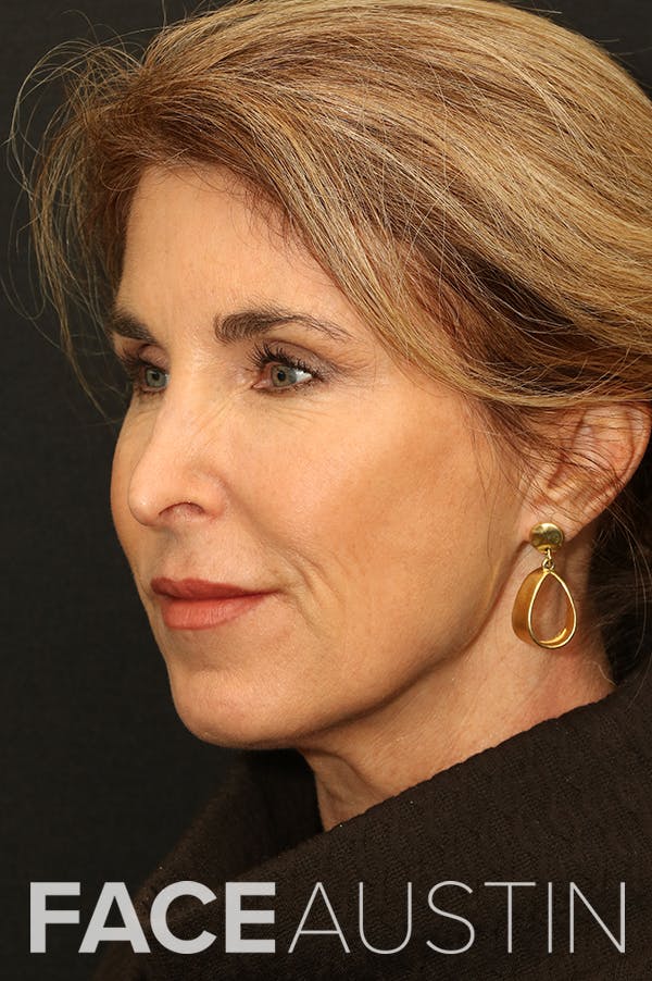 Facelift Before & After Gallery - Patient 24311071 - Image 1