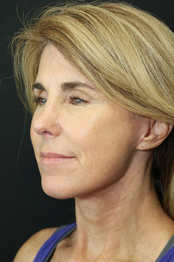 Facelift Before & After Gallery - Patient 24311071 - Image 2