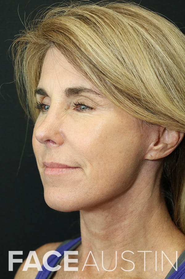 Facelift Before & After Gallery - Patient 24311071 - Image 2
